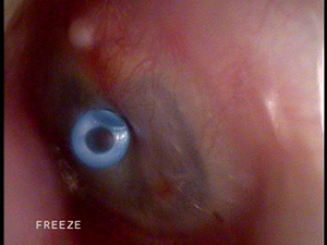 鼓膜換気チューブ